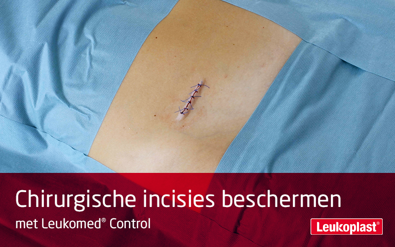 Deze film laat zien hoe chirurgische wonden tijdens hun genezingsproces kunnen worden beschermd: We zien de handen van een zorgprofessional die een chirurgische incisie bedekt met Leukomed Control. Deze film laat zien hoe chirurgische wonden tijdens hun genezingsproces kunnen worden beschermd: We zien de handen van een zorgprofessional die een chirurgische incisie bedekt met Leukomed Control.